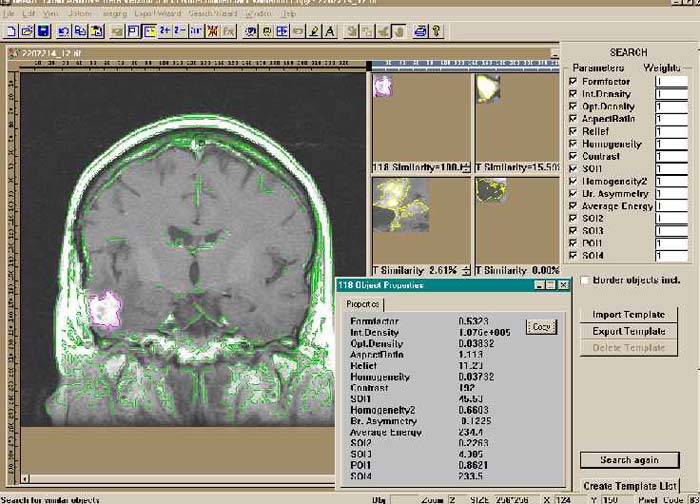 Tumor Templates